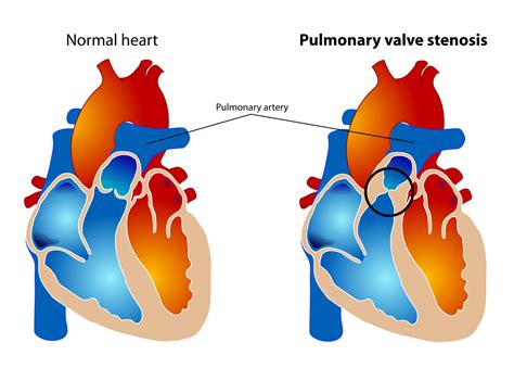 Common Health Issues: Pulmonary Stenosis